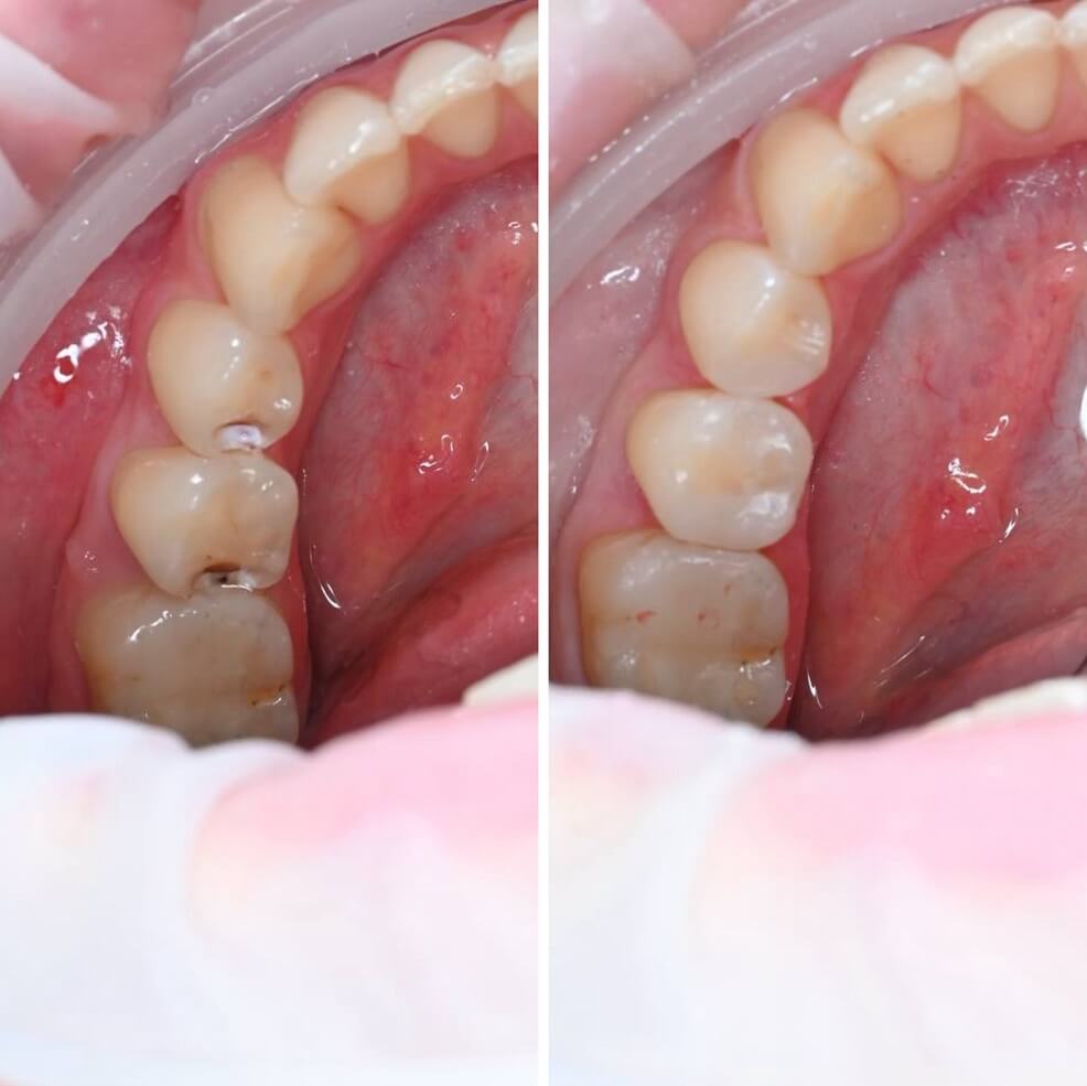 Что такое кариес и как его лечить?