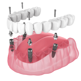 all on 4 имплантация под ключ