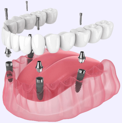 Имплантация All On 4