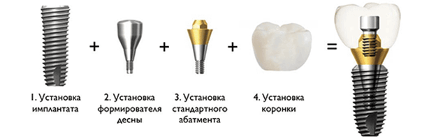 Имплантация зубов под ключ Пермь цена